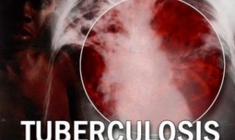 Di Tengah Covid-19, Pemkab Ciamis Tak Abaikan Tuberkulosis